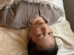 美容鍼施術しているところしているところ